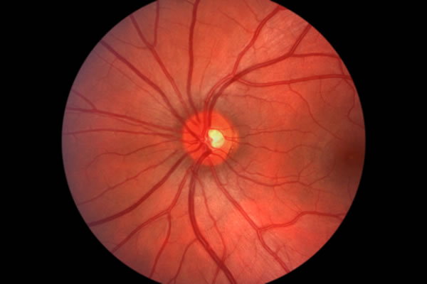 Human Retina - Optic Nerve